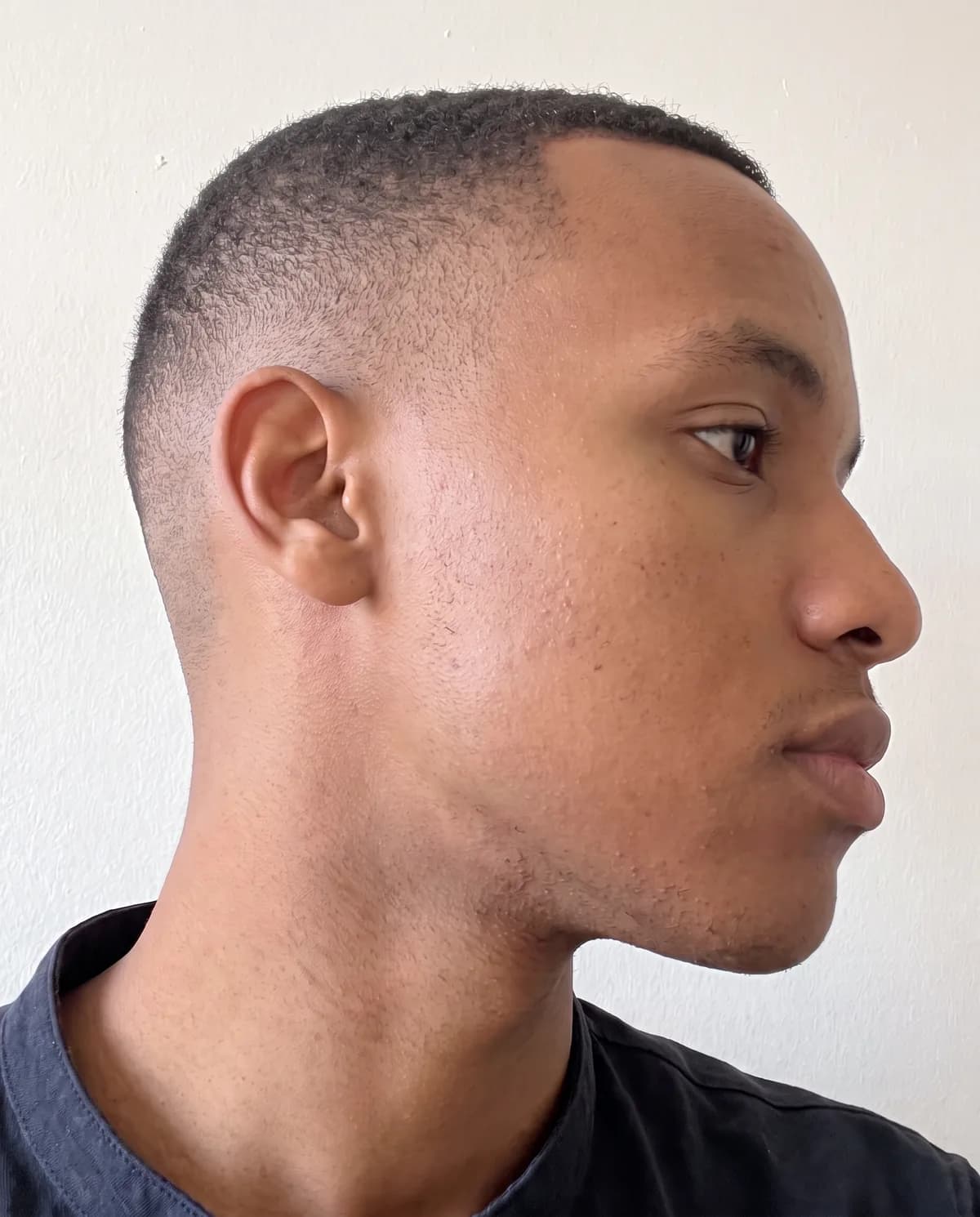 After: a young man's jaw and neck, photographed in daylight